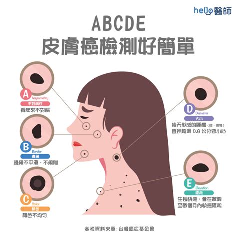 凸痣長毛|痣形成的原因？痣長毛、痣變多變大是痣病變？5招判。